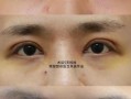 割双眼皮美容(割双眼皮美容院需要什么资质)
