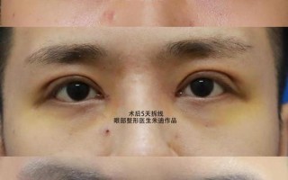 割双眼皮美容(割双眼皮美容院需要什么资质)